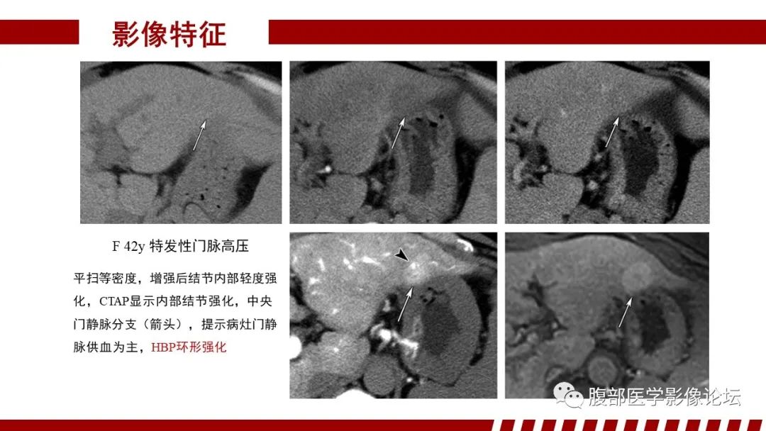 影像PPT - 【PPT】肝胆期高信号的病变影像表现及临床意义-32