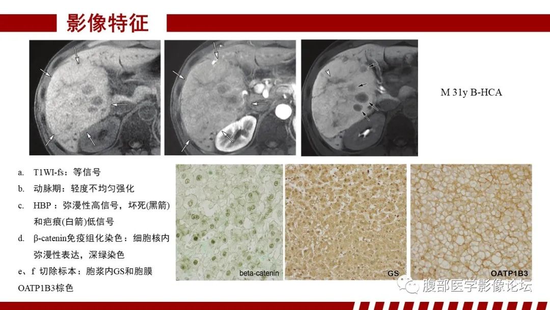影像PPT - 【PPT】肝胆期高信号的病变影像表现及临床意义-38