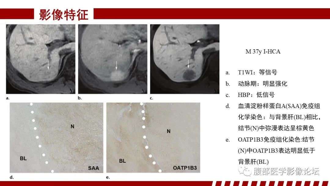 影像PPT - 【PPT】肝胆期高信号的病变影像表现及临床意义-40