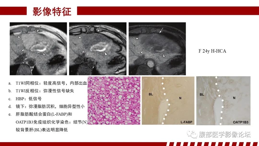 影像PPT - 【PPT】肝胆期高信号的病变影像表现及临床意义-43
