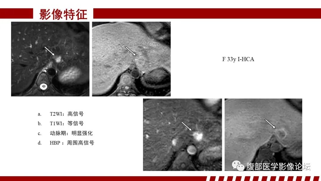 影像PPT - 【PPT】肝胆期高信号的病变影像表现及临床意义-41
