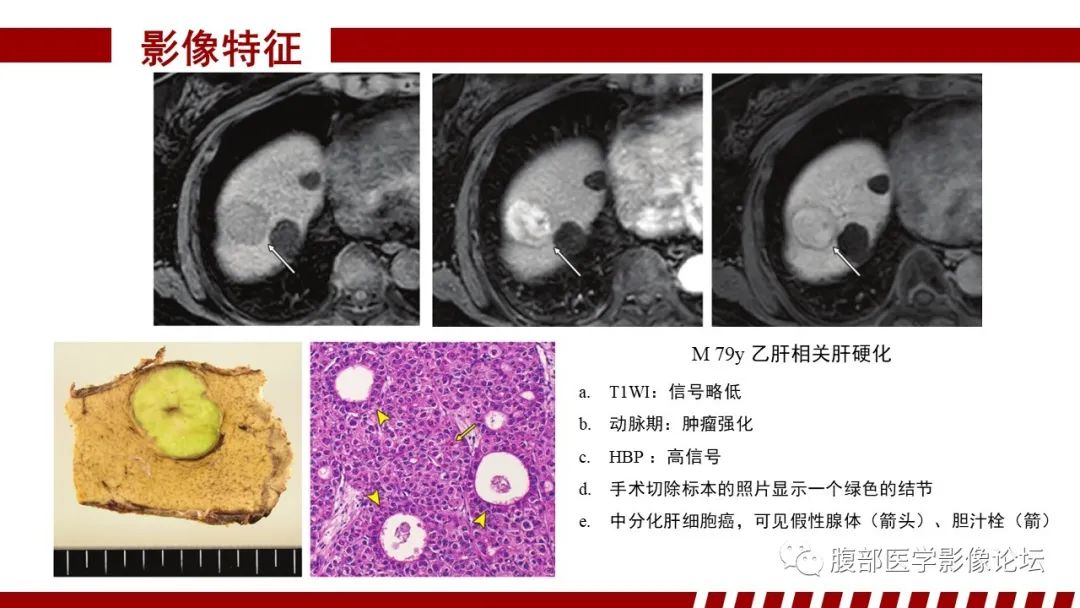 影像PPT - 【PPT】肝胆期高信号的病变影像表现及临床意义-46