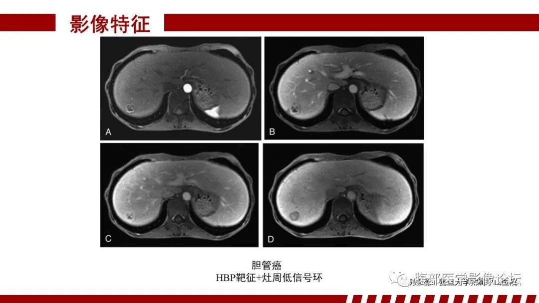 影像PPT - 【PPT】肝胆期高信号的病变影像表现及临床意义-50