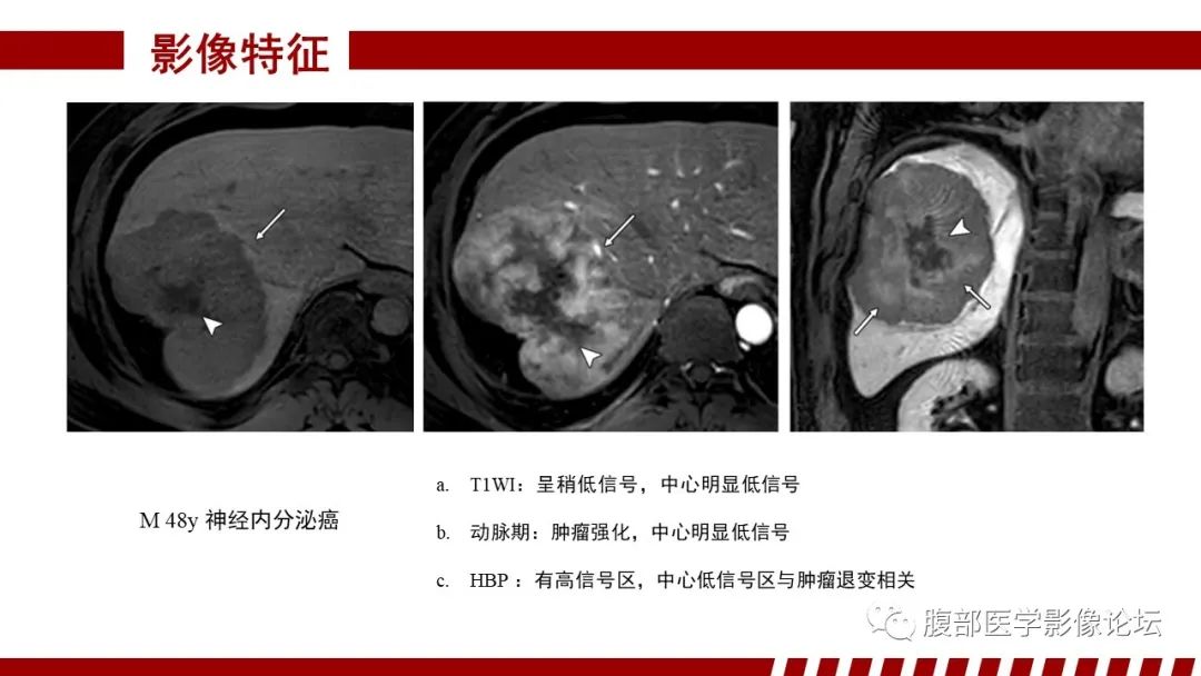 影像PPT - 【PPT】肝胆期高信号的病变影像表现及临床意义-52