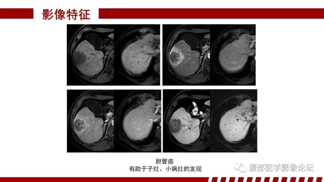 影像PPT - 【PPT】肝胆期高信号的病变影像表现及临床意义-51