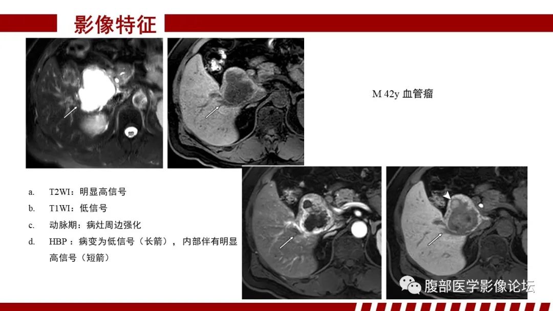 影像PPT - 【PPT】肝胆期高信号的病变影像表现及临床意义-54
