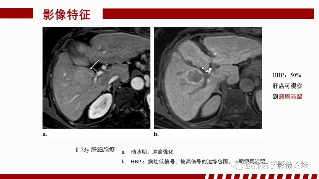 影像PPT - 【PPT】肝胆期高信号的病变影像表现及临床意义-57