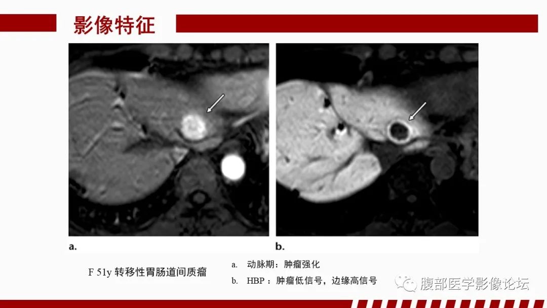 影像PPT - 【PPT】肝胆期高信号的病变影像表现及临床意义-58