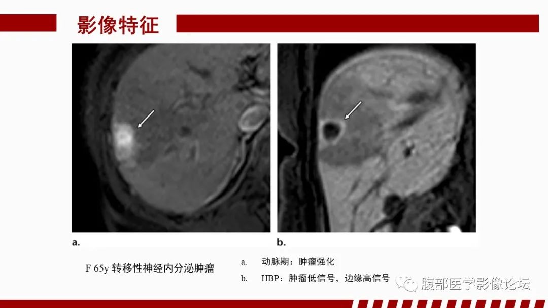 影像PPT - 【PPT】肝胆期高信号的病变影像表现及临床意义-59