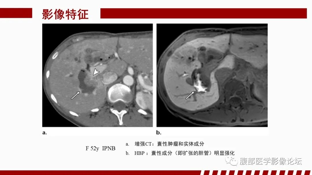 影像PPT - 【PPT】肝胆期高信号的病变影像表现及临床意义-66