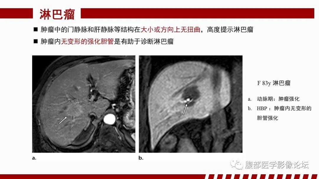 影像PPT - 【PPT】肝胆期高信号的病变影像表现及临床意义-64