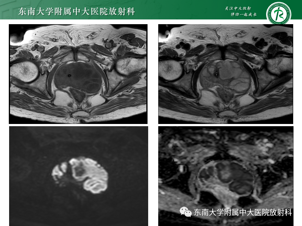 影像PPT - 【PPT】前列腺脓肿-3 影像PPT - 【PPT】前列腺脓肿-3