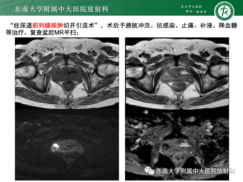 影像PPT - 【PPT】前列腺脓肿-4 影像PPT - 【PPT】前列腺脓肿-4