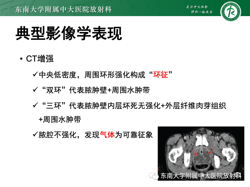 影像PPT - 【PPT】前列腺脓肿-17 影像PPT - 【PPT】前列腺脓肿-17