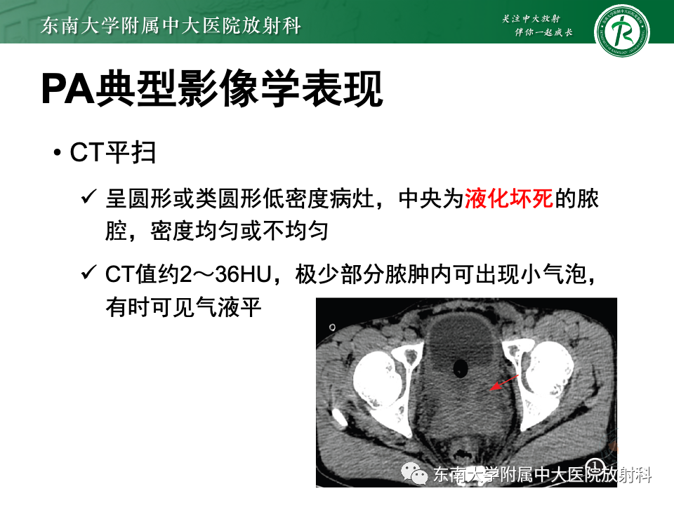 影像PPT - 【PPT】前列腺脓肿-16 影像PPT - 【PPT】前列腺脓肿-16