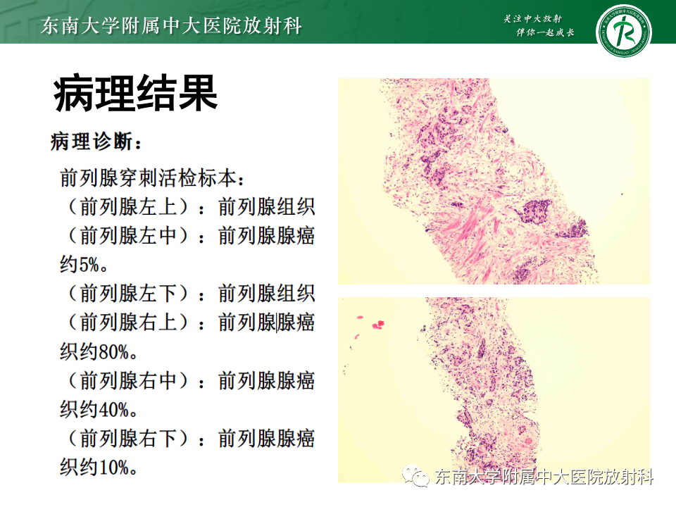 影像PPT - 【PPT】前列腺脓肿-22 影像PPT - 【PPT】前列腺脓肿-22