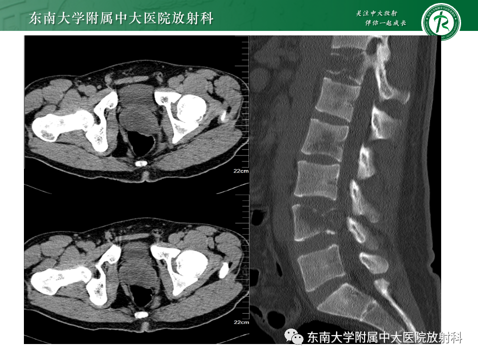 影像PPT - 【PPT】前列腺脓肿-28 影像PPT - 【PPT】前列腺脓肿-28