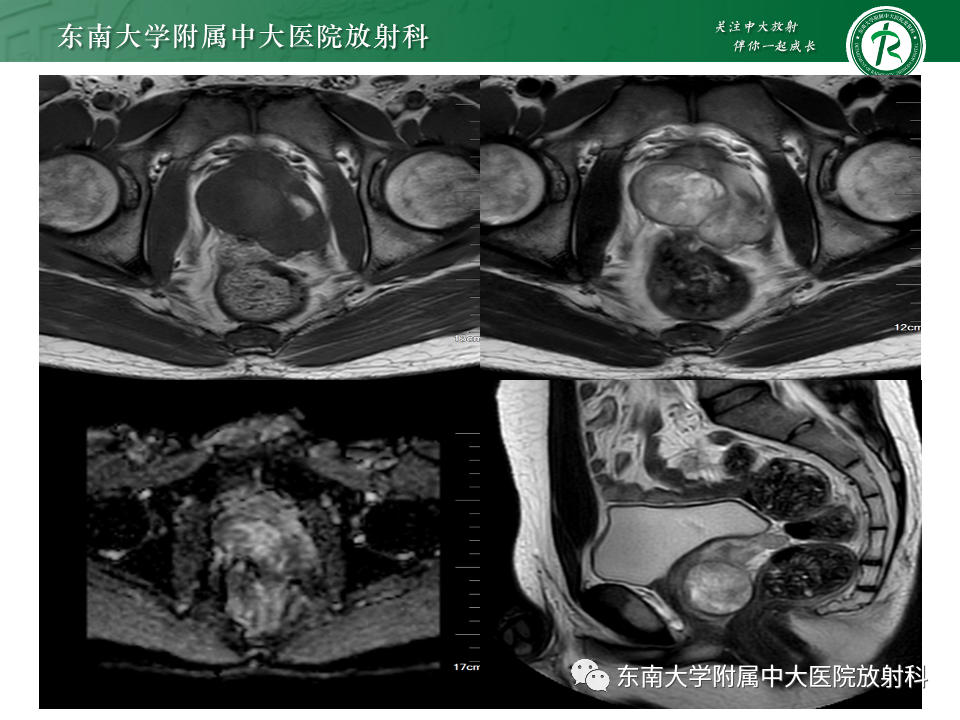 影像PPT - 【PPT】前列腺脓肿-29 影像PPT - 【PPT】前列腺脓肿-29