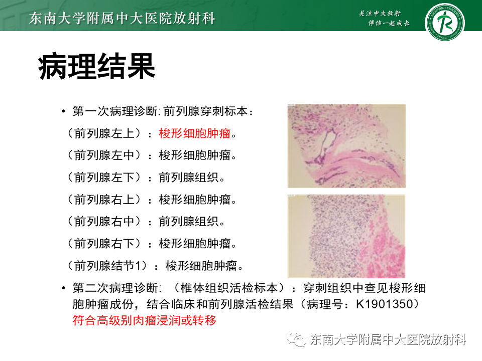 影像PPT - 【PPT】前列腺脓肿-30 影像PPT - 【PPT】前列腺脓肿-30