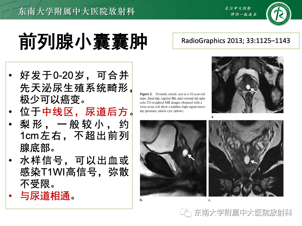 影像PPT - 【PPT】前列腺脓肿-35 影像PPT - 【PPT】前列腺脓肿-35