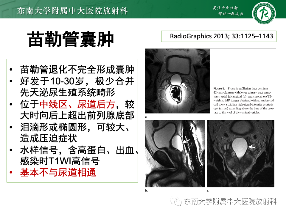 影像PPT - 【PPT】前列腺脓肿-36 影像PPT - 【PPT】前列腺脓肿-36