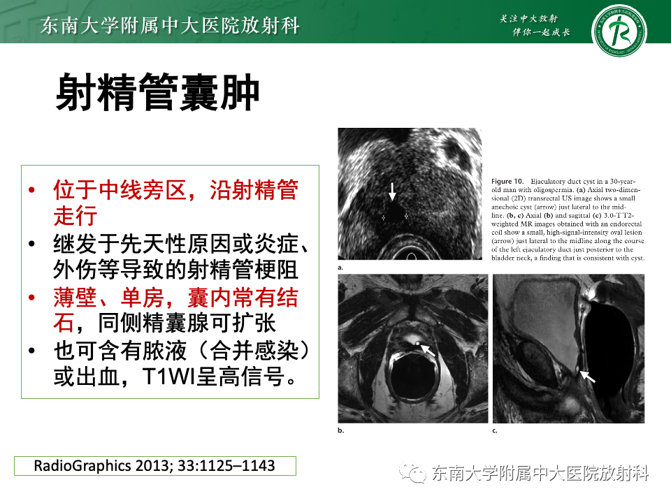 影像PPT - 【PPT】前列腺脓肿-38 影像PPT - 【PPT】前列腺脓肿-38