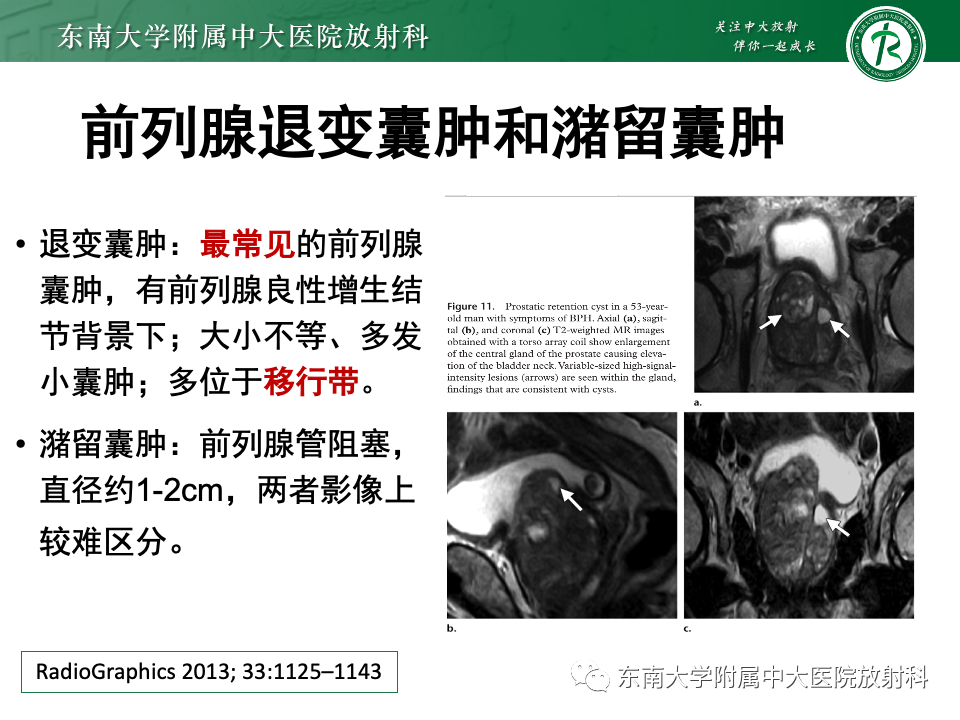 影像PPT - 【PPT】前列腺脓肿-39 影像PPT - 【PPT】前列腺脓肿-39