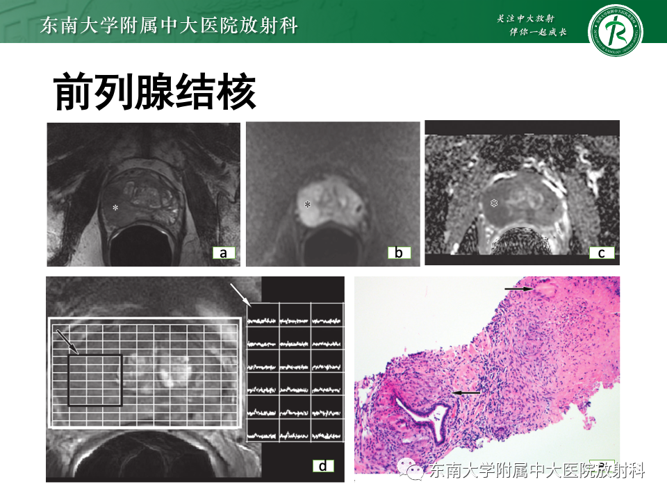 影像PPT - 【PPT】前列腺脓肿-41 影像PPT - 【PPT】前列腺脓肿-41