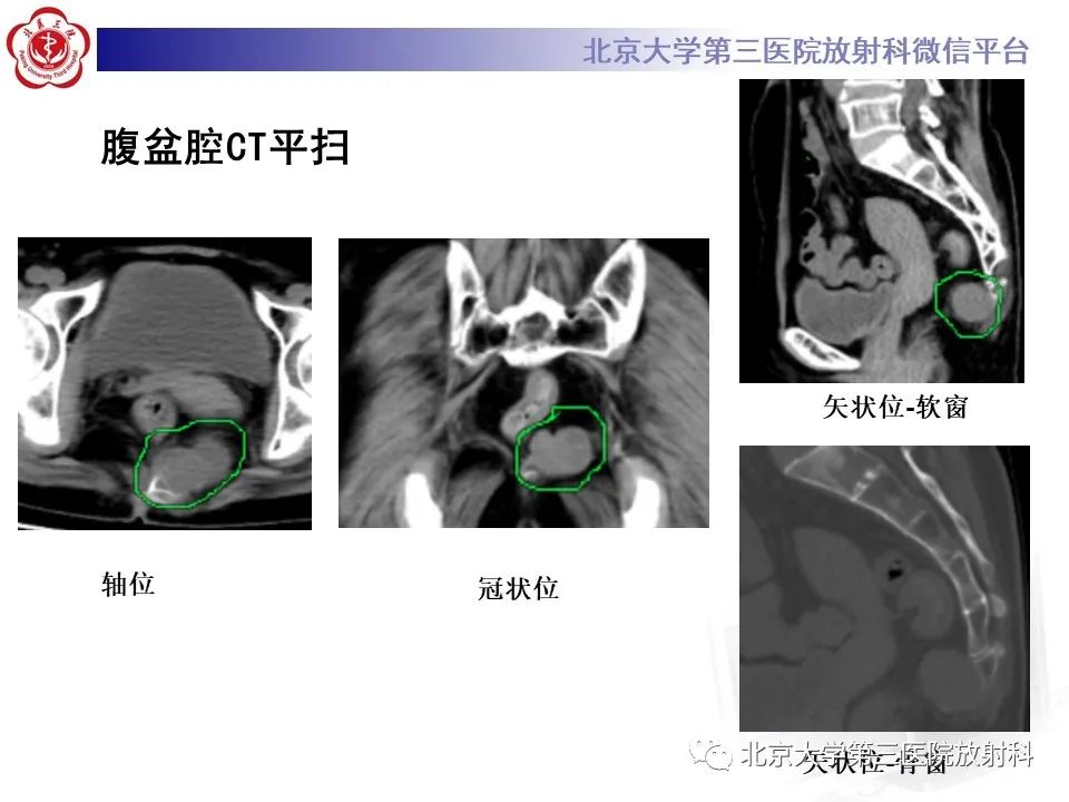 影像PPT - 【PPT】骶尾部原发性脊索瘤-3