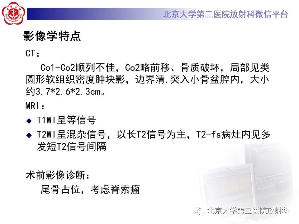 影像PPT - 【PPT】骶尾部原发性脊索瘤-6