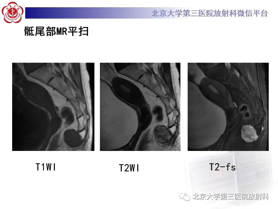 影像PPT - 【PPT】骶尾部原发性脊索瘤-4