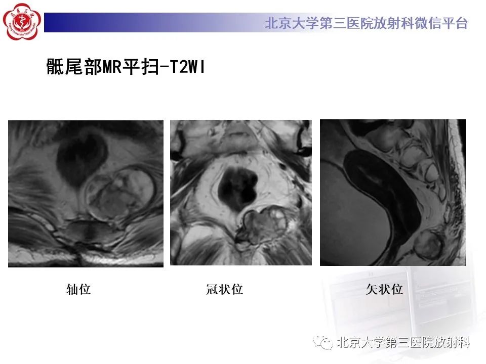 影像PPT - 【PPT】骶尾部原发性脊索瘤-5