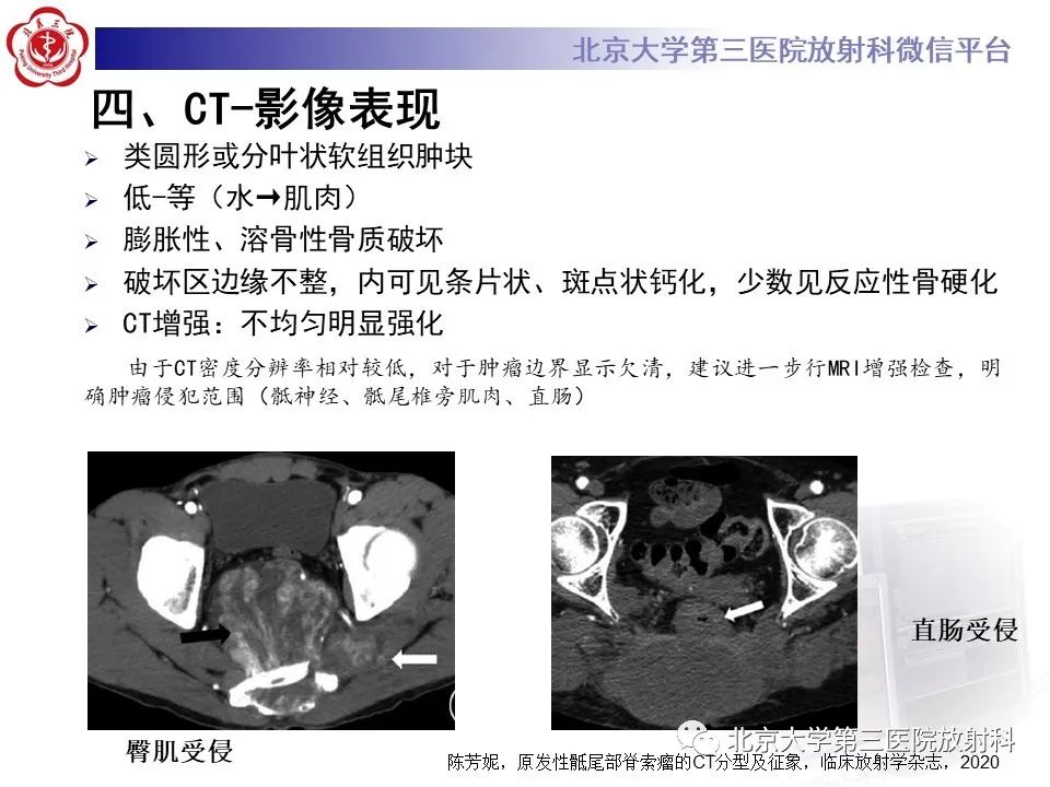 影像PPT - 【PPT】骶尾部原发性脊索瘤-13