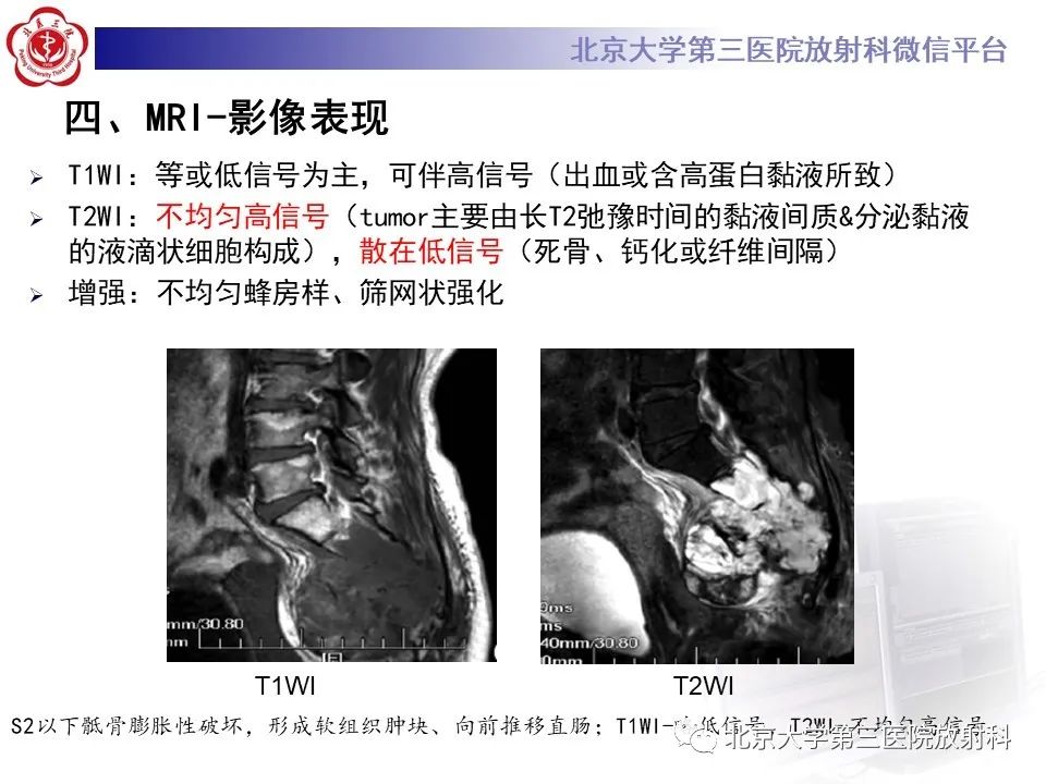 影像PPT - 【PPT】骶尾部原发性脊索瘤-14