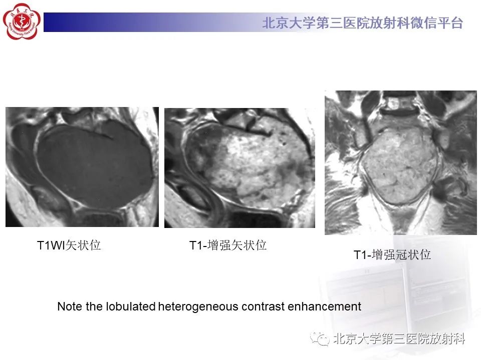 影像PPT - 【PPT】骶尾部原发性脊索瘤-15