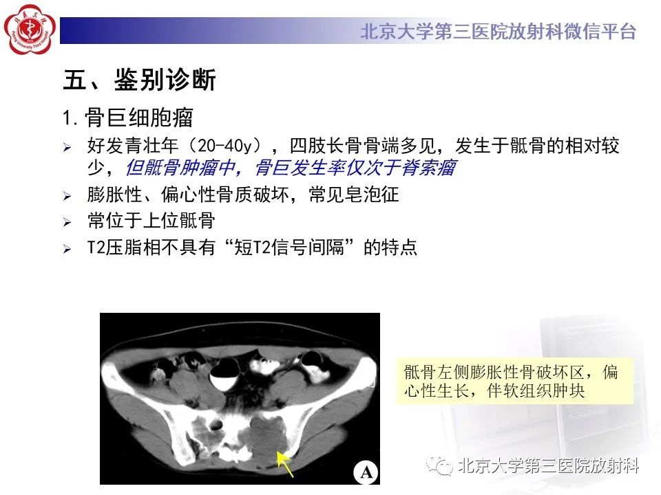 影像PPT - 【PPT】骶尾部原发性脊索瘤-16