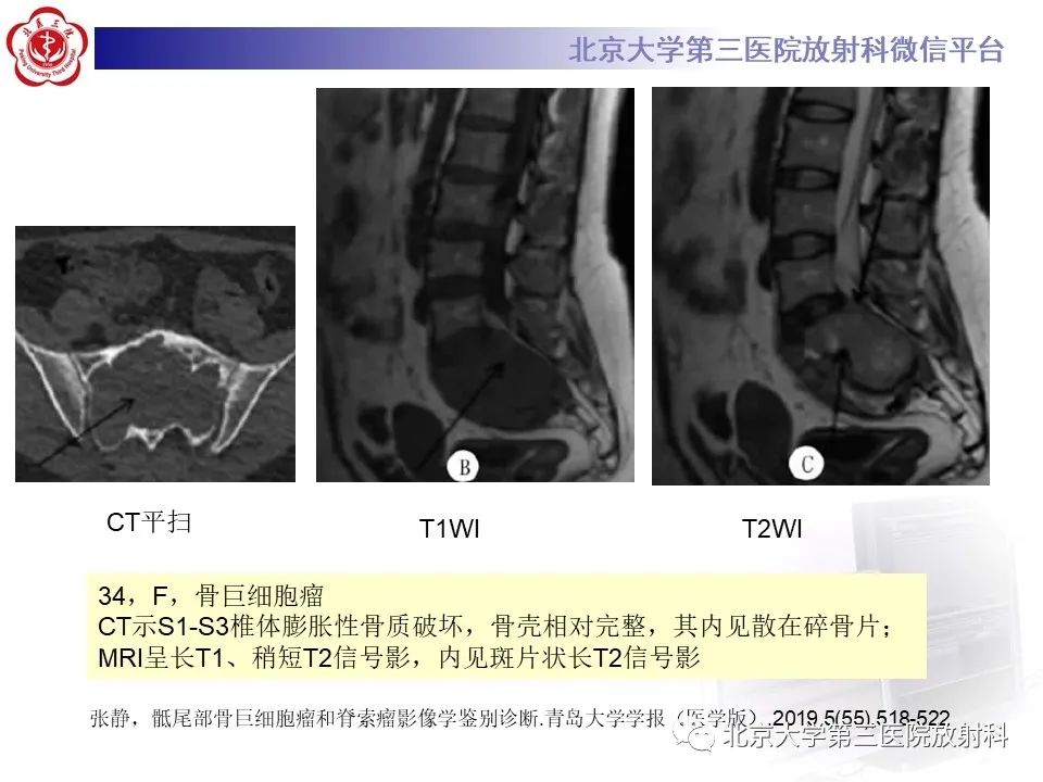 影像PPT - 【PPT】骶尾部原发性脊索瘤-17