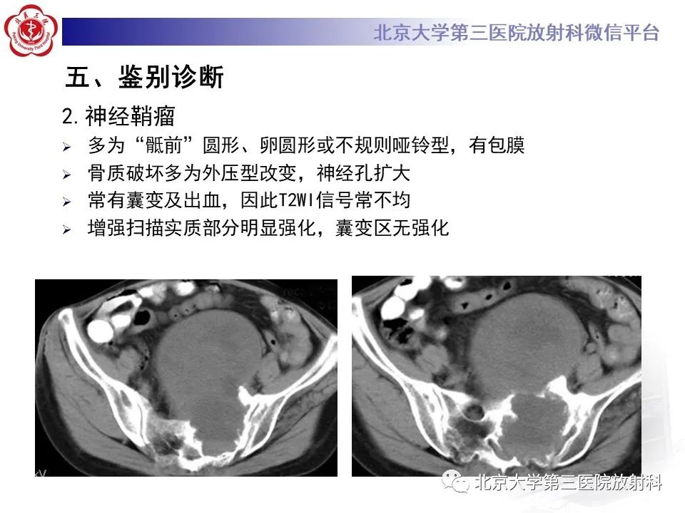 影像PPT - 【PPT】骶尾部原发性脊索瘤-19