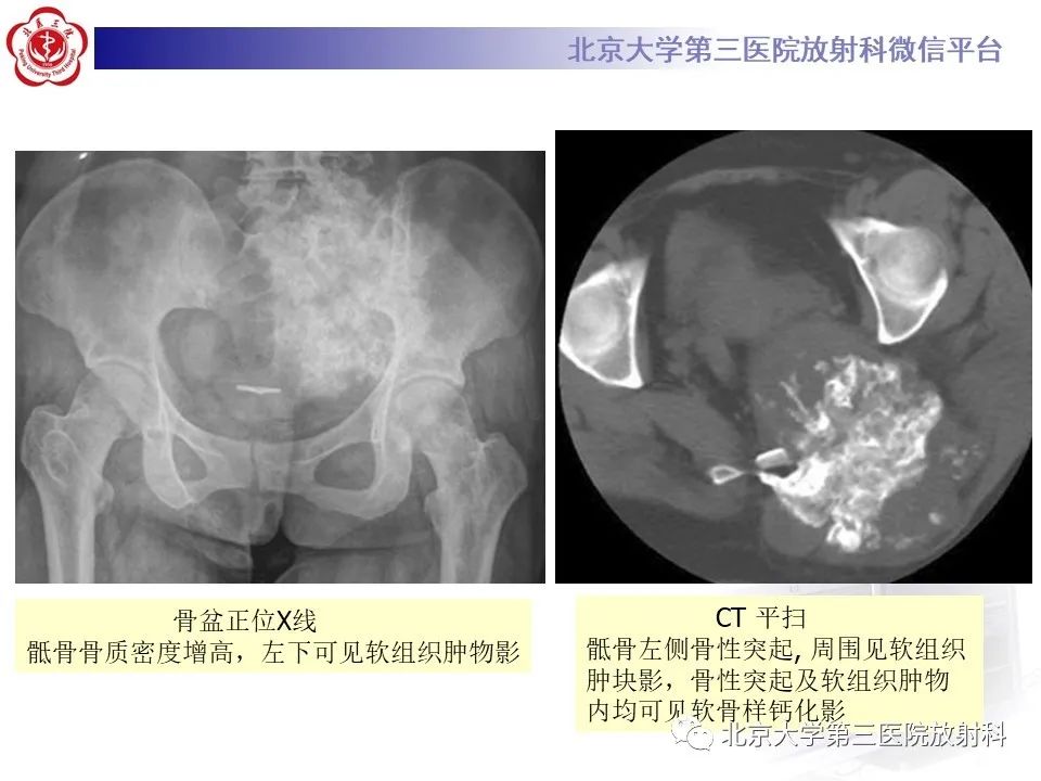 影像PPT - 【PPT】骶尾部原发性脊索瘤-21