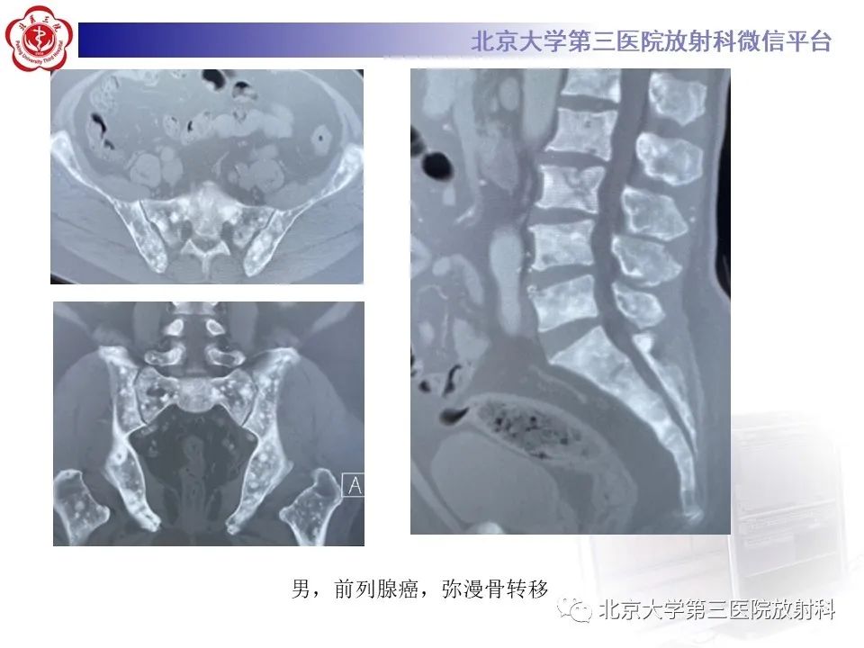 影像PPT - 【PPT】骶尾部原发性脊索瘤-23