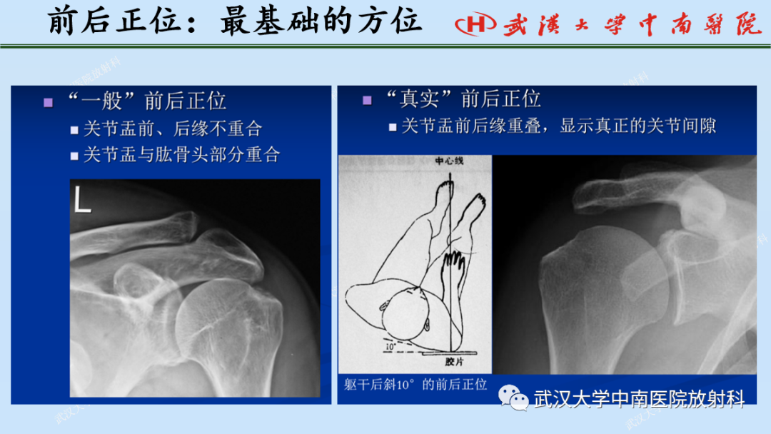 影像PPT - 【PPT】肩关节的MR影像解剖及其慢性损伤-9
