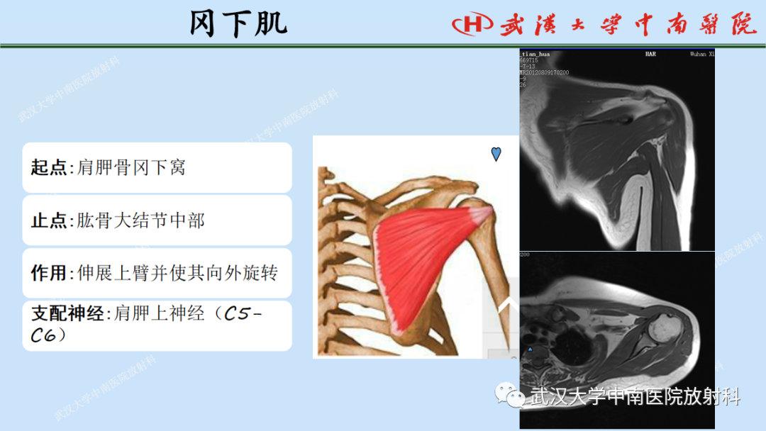 影像PPT - 【PPT】肩关节的MR影像解剖及其慢性损伤-18
