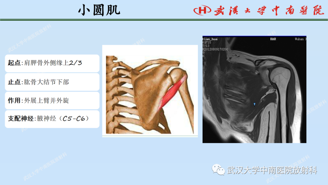 影像PPT - 【PPT】肩关节的MR影像解剖及其慢性损伤-20