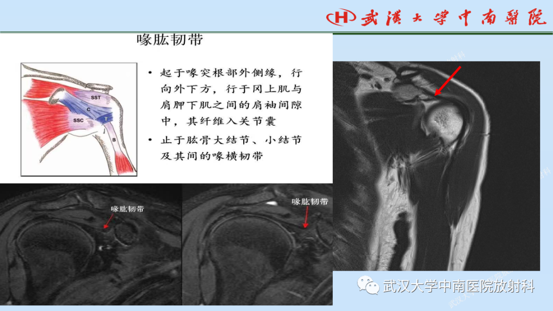 影像PPT - 【PPT】肩关节的MR影像解剖及其慢性损伤-15