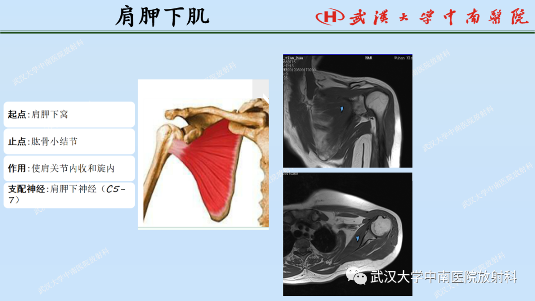影像PPT - 【PPT】肩关节的MR影像解剖及其慢性损伤-19