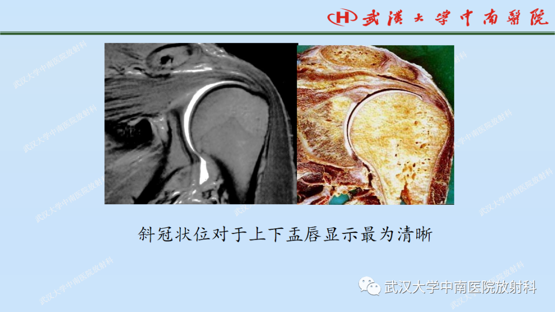 影像PPT - 【PPT】肩关节的MR影像解剖及其慢性损伤-28