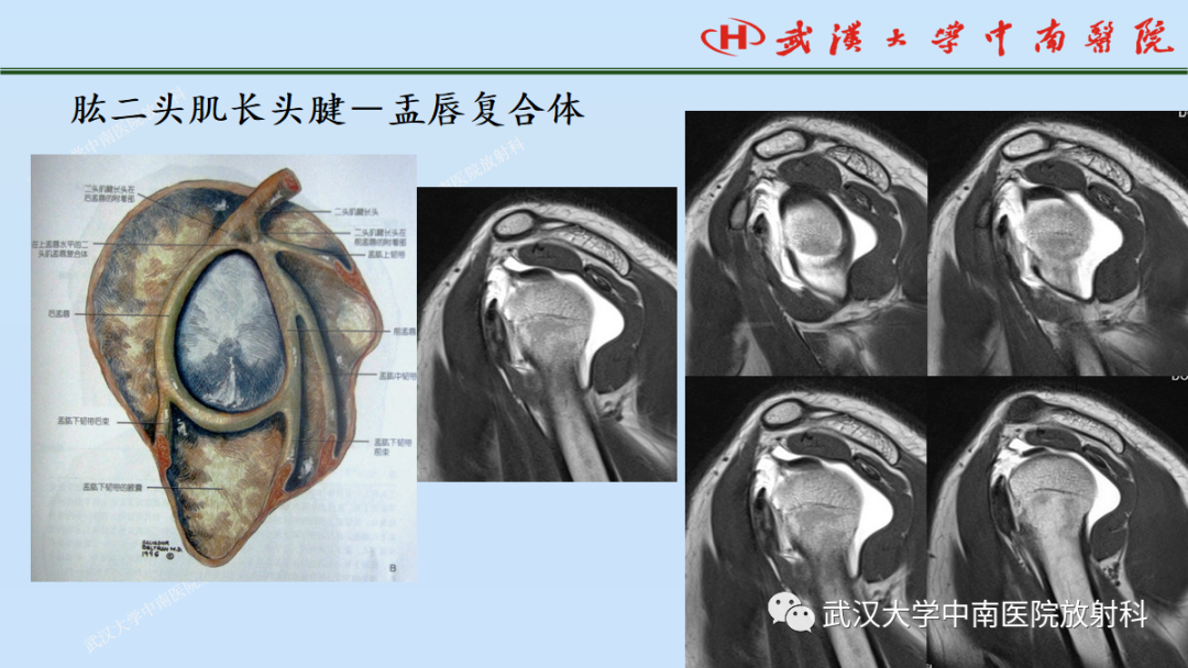 影像PPT - 【PPT】肩关节的MR影像解剖及其慢性损伤-29