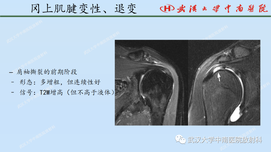 影像PPT - 【PPT】肩关节的MR影像解剖及其慢性损伤-39