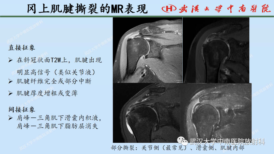 影像PPT - 【PPT】肩关节的MR影像解剖及其慢性损伤-40