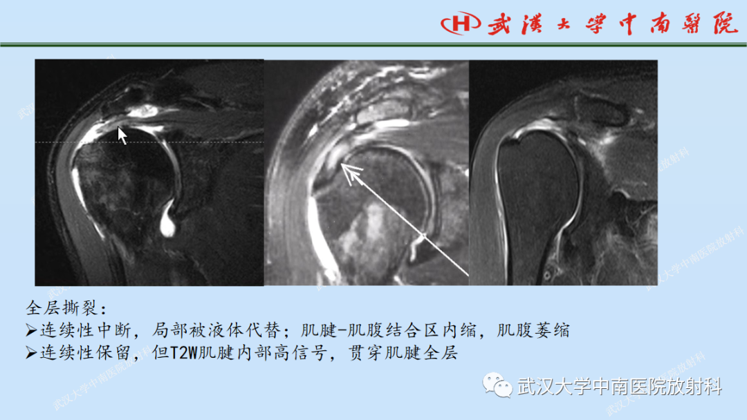 影像PPT - 【PPT】肩关节的MR影像解剖及其慢性损伤-41